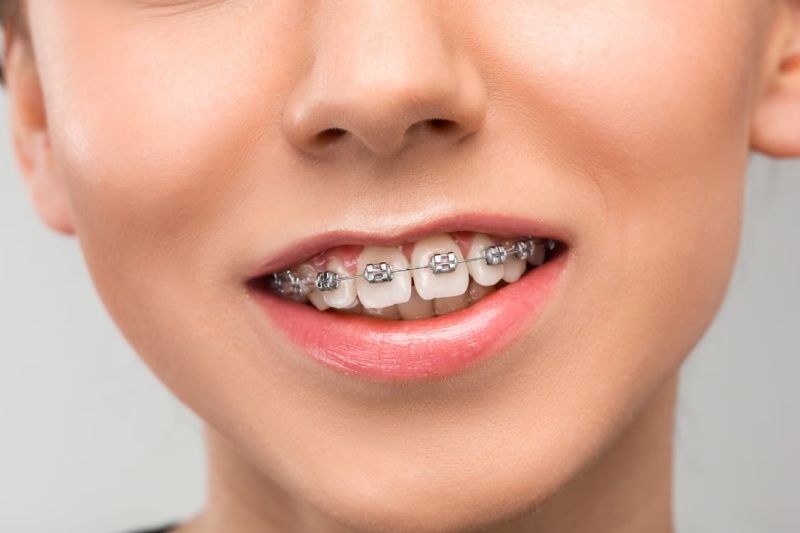 Braket (Diş Teli) Tedavisi