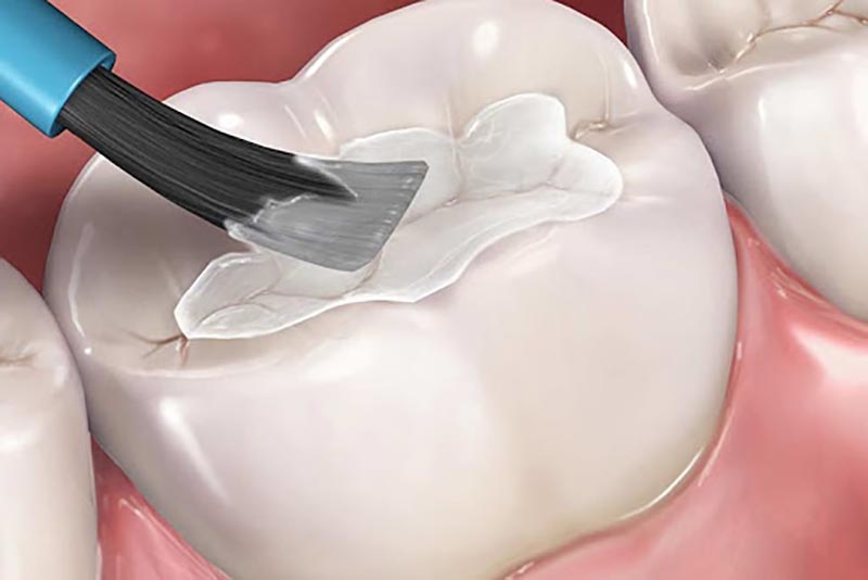 Fissure Sealants