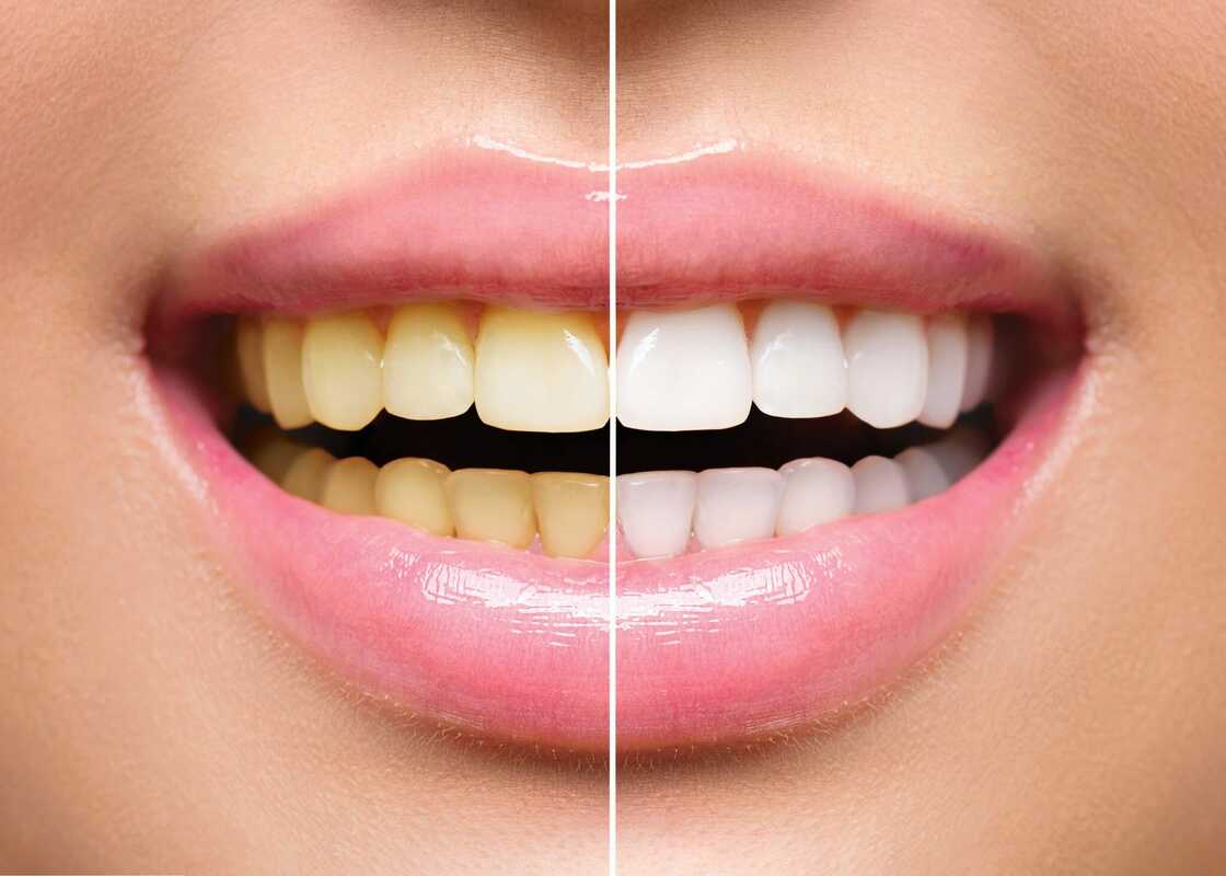 Coloration in teeth