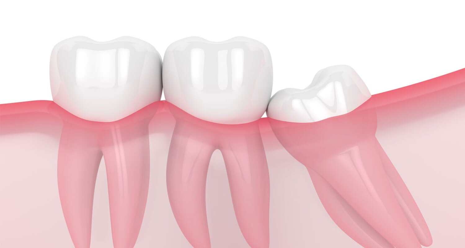 Wisdom Teeth